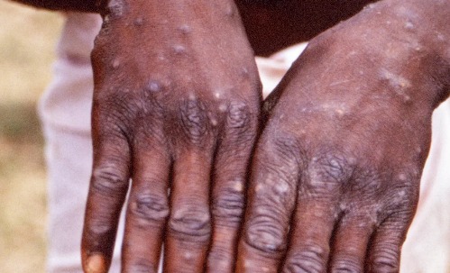 Health: Nigeria reports 39 confirmed cases of mpox