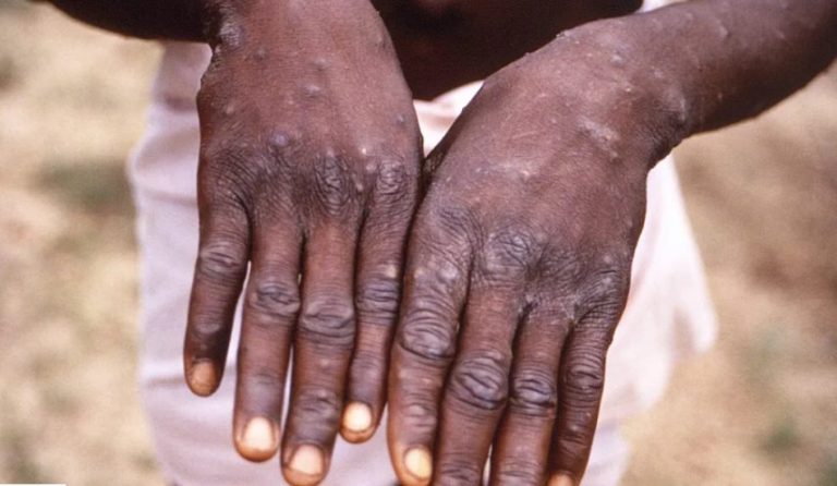 Namibia confirms first Mpox case